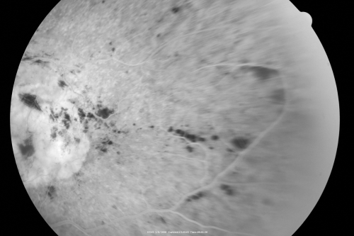 Central Retinal Vein Occlusion - New- and old Macular Scar from AMD
87-year-old woman with longstaning macular scars and new vision loss left eye for 2 months. OD:  20/200, OS 20/400. 

