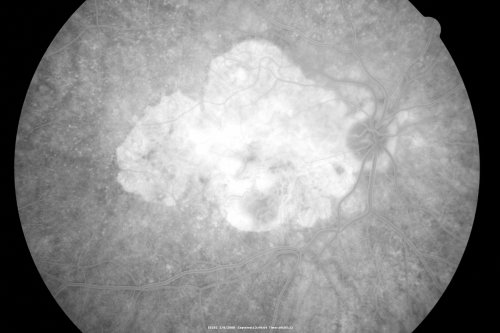 Central Retinal Vein Occlusion - New- and old Macular Scar from AMD
87-year-old woman with longstaning macular scars and new vision loss left eye for 2 months. OD:  20/200, OS 20/400. 
