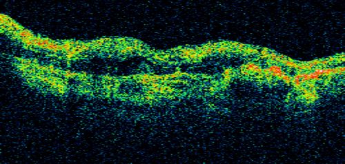 Central Retinal Vein Occlusion - New- and old Macular Scar from AMD
87-year-old woman with longstaning macular scars and new vision loss left eye for 2 months. OD:  20/200, OS 20/400. 
