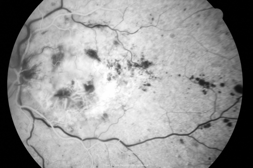 Central Retinal Vein Occlusion - New- and old Macular Scar from AMD
87-year-old woman with longstaning macular scars and new vision loss left eye for 2 months. OD:  20/200, OS 20/400. 
