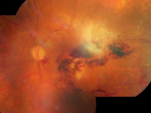 Central Retinal Vein Occlusion and Tractional Retinal Detachment for 3 Years (Patient is Diabetic)
67-year-old woman has severe vision loss in the left eye for 3 years  OD 20/32,  OS 3/200
