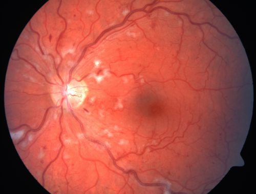 Non-Ischemic Central Retinal Vein Occlusion in Young Man (30 years) - Many Cotton Wool Spots
30-year-old man with a history of a central retinal vein occlusion for which he was first examined on 2 months ago and his vision then was 4/200.  He responded nicely to two Avastin treatments. OD is 20/20, OS is 20/60
