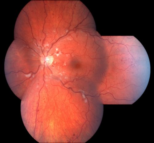Non-Ischemic Central Retinal Vein Occlusion in Young Man (30 years) - Many Cotton Wool Spots
30-year-old man with a history of a central retinal vein occlusion for which he was first examined on 2 months ago and his vision then was 4/200.  He responded nicely to two Avastin treatments. OD is 20/20, OS is 20/60
