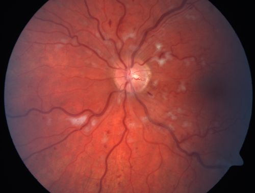 Non-Ischemic Central Retinal Vein Occlusion in Young Man (30 years) - Many Cotton Wool Spots
30-year-old man with a history of a central retinal vein occlusion for which he was first examined on 2 months ago and his vision then was 4/200.  He responded nicely to two Avastin treatments. OD is 20/20, OS is 20/60
