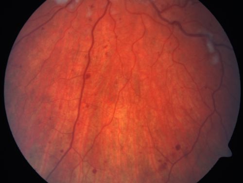 Non-Ischemic Central Retinal Vein Occlusion in Young Man (30 years) - Many Cotton Wool Spots
30-year-old man with a history of a central retinal vein occlusion for which he was first examined on 2 months ago and his vision then was 4/200.  He responded nicely to two Avastin treatments. OD is 20/20, OS is 20/60
