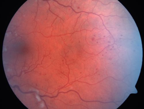 Non-Ischemic Central Retinal Vein Occlusion in Young Man (30 years) - Many Cotton Wool Spots
30-year-old man with a history of a central retinal vein occlusion for which he was first examined on 2 months ago and his vision then was 4/200.  He responded nicely to two Avastin treatments. OD is 20/20, OS is 20/60
