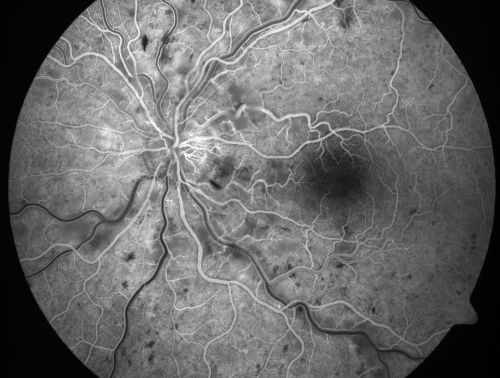 Non-Ischemic Central Retinal Vein Occlusion in Young Man (30 years) - Many Cotton Wool Spots
30-year-old man with a history of a central retinal vein occlusion for which he was first examined on 2 months ago and his vision then was 4/200.  He responded nicely to two Avastin treatments. OD is 20/20, OS is 20/60
