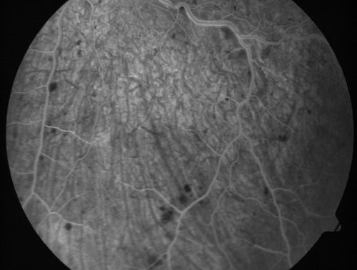 Non-Ischemic Central Retinal Vein Occlusion in Young Man (30 years) - Many Cotton Wool Spots
30-year-old man with a history of a central retinal vein occlusion for which he was first examined on 2 months ago and his vision then was 4/200.  He responded nicely to two Avastin treatments. OD is 20/20, OS is 20/60
