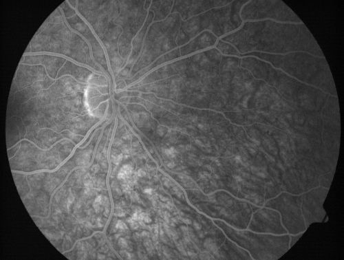 Non-Ischemic Central Retinal Vein Occlusion in Young Man (30 years) - Many Cotton Wool Spots
30-year-old man with a history of a central retinal vein occlusion for which he was first examined on 2 months ago and his vision then was 4/200.  He responded nicely to two Avastin treatments. OD is 20/20, OS is 20/60
