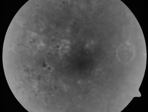 Clinically Significant Diabetic Macular Edema both Eyes with Exudates
56-year-old woman with diabetes for twelve years.  She has noticed blurring of the vision in the right eye for about six months.  OD is 20/70, OS is 20/25. 
