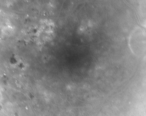 Clinically Significant Diabetic Macular Edema both Eyes with Exudates
56-year-old woman with diabetes for twelve years.  She has noticed blurring of the vision in the right eye for about six months.  OD is 20/70, OS is 20/25. 
