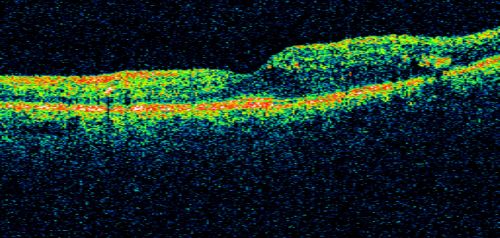 Clinically Significant Diabetic Macular Edema both Eyes with Exudates
56-year-old woman with diabetes for twelve years.  She has noticed blurring of the vision in the right eye for about six months.  OD is 20/70, OS is 20/25. 
