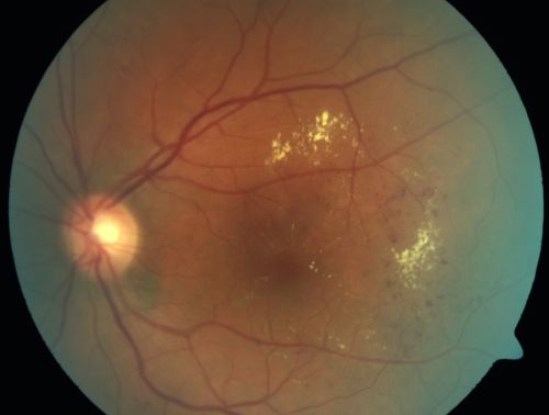 Clinically Significant Diabetic Macular Edema both Eyes with Exudates
56-year-old woman with diabetes for twelve years.  She has noticed blurring of the vision in the right eye for about six months.  OD is 20/70, OS is 20/25. 
