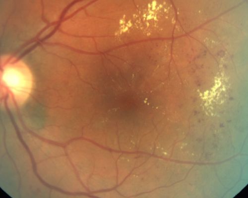Clinically Significant Diabetic Macular Edema both Eyes with Exudates
56-year-old woman with diabetes for twelve years.  She has noticed blurring of the vision in the right eye for about six months.  OD is 20/70, OS is 20/25. 

