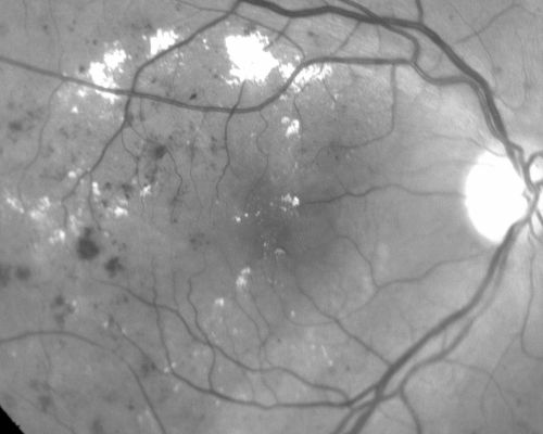 Clinically Significant Diabetic Macular Edema both Eyes with Exudates
56-year-old woman with diabetes for twelve years.  She has noticed blurring of the vision in the right eye for about six months.  OD is 20/70, OS is 20/25. 
