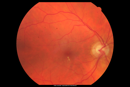 Diabetic Macular Edema - Mild
70 year old man with mild edema did well without treatment
