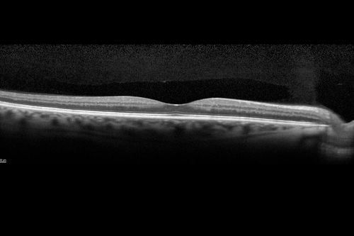Diabetic Macular Edema - Mild
70 year old man with mild edema did well without treatment
