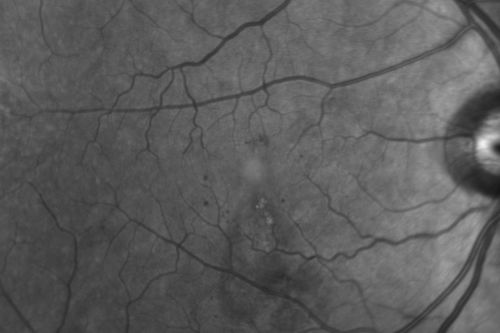 63-year-old man diabetic for twenty two years.  His central vision is fine. 

VISUAL ACUITY:  OD 20/25,  OS 20/25
