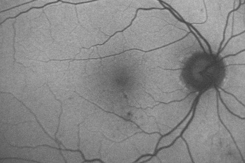 63-year-old man diabetic for twenty two years.  His central vision is fine. 

VISUAL ACUITY:  OD 20/25,  OS 20/25
