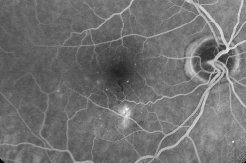 Diabetic Macular Edema - Mild
70 year old man with mild edema did well without treatment
