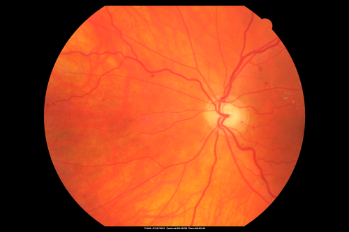 63-year-old man diabetic for twenty two years.  His central vision is fine. 

VISUAL ACUITY:  OD 20/25,  OS 20/25
