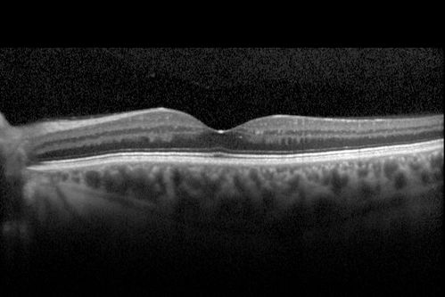 63-year-old man diabetic for twenty two years.  His central vision is fine. 

VISUAL ACUITY:  OD 20/25,  OS 20/25
