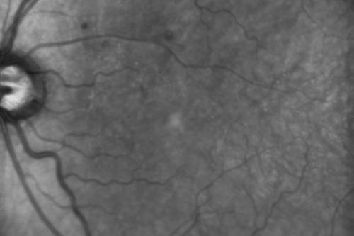 Diabetic Macular Edema - Mild
70 year old man with mild edema did well without treatment
