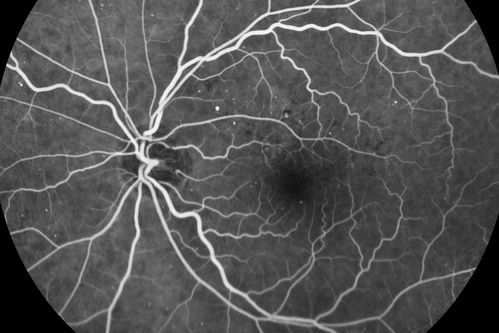 Diabetic Macular Edema - Mild
70 year old man with mild edema did well without treatment
