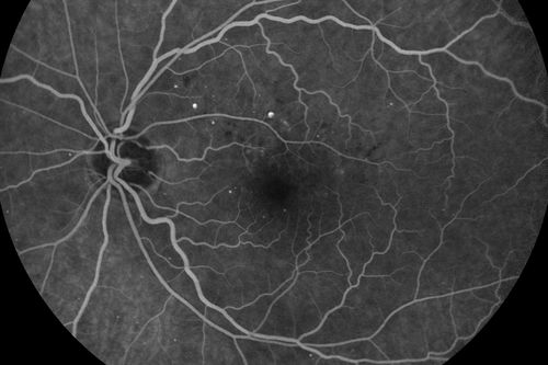 63-year-old man diabetic for twenty two years.  His central vision is fine. 

VISUAL ACUITY:  OD 20/25,  OS 20/25
