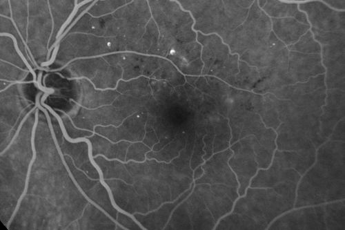 Diabetic Macular Edema - Mild
70 year old man with mild edema did well without treatment

