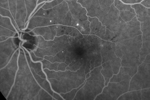 Diabetic Macular Edema - Mild
70 year old man with mild edema did well without treatment
