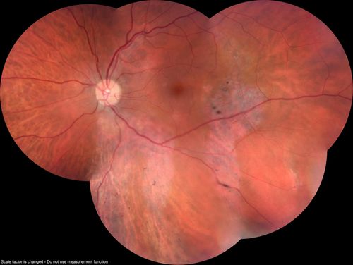 Normal Vision - Chronic Central Serous Chorioretinopathy
67 year old man - never had any symptoms - 20/16 vision in each eye.  Lesions spare the fovea
