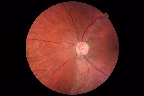 Normal Vision - Chronic Central Serous Chorioretinopathy
67 year old man - never had any symptoms - 20/16 vision in each eye.  Lesions spare the fovea
