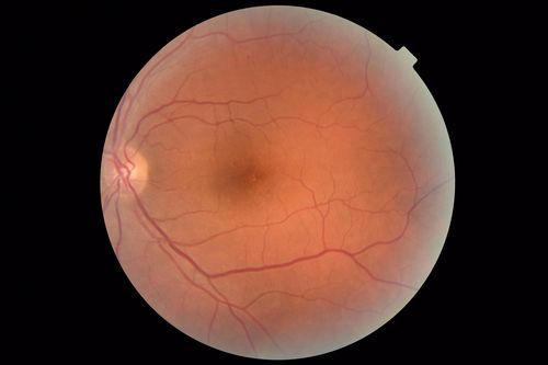 Central Serous Chorioretinopathy - Moderate
49 year old man with episodes in 2011, 2017, and 2018 - now with some paracentral vision loss in the right eye and subretinal fluid.
