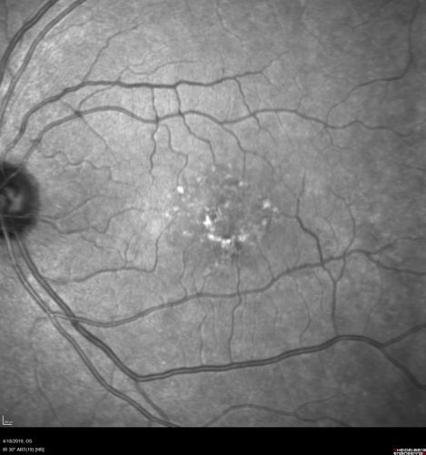Central Serous Chorioretinopathy - Moderate
49 year old man with episodes in 2011, 2017, and 2018 - now with some paracentral vision loss in the right eye and subretinal fluid.
