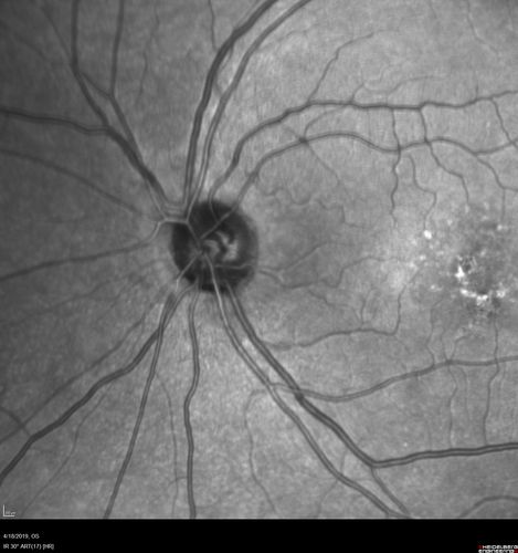 Central Serous Chorioretinopathy - Moderate
49 year old man with episodes in 2011, 2017, and 2018 - now with some paracentral vision loss in the right eye and subretinal fluid.
