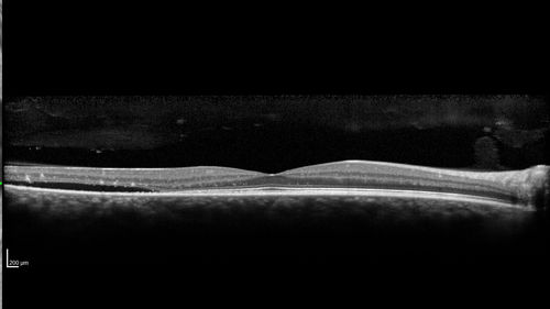 Central Serous Chorioretinopathy - Moderate
49 year old man with episodes in 2011, 2017, and 2018 - now with some paracentral vision loss in the right eye and subretinal fluid.
