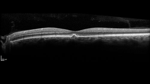 Central Serous Chorioretinopathy - Moderate
49 year old man with episodes in 2011, 2017, and 2018 - now with some paracentral vision loss in the right eye and subretinal fluid.
