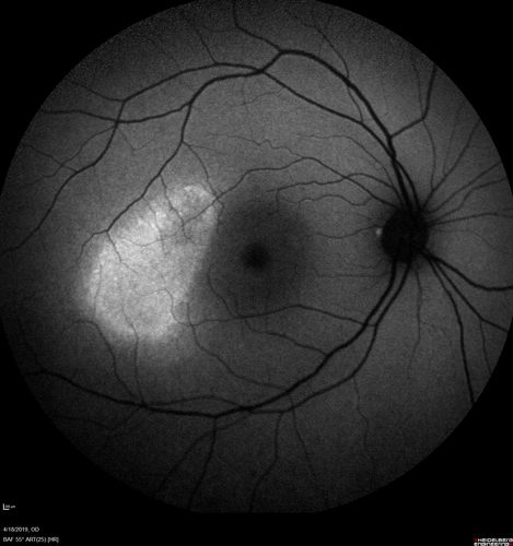 Central Serous Chorioretinopathy - Moderate
49 year old man with episodes in 2011, 2017, and 2018 - now with some paracentral vision loss in the right eye and subretinal fluid.
