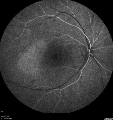 Central Serous Chorioretinopathy - Moderate
49 year old man with episodes in 2011, 2017, and 2018 - now with some paracentral vision loss in the right eye and subretinal fluid.
