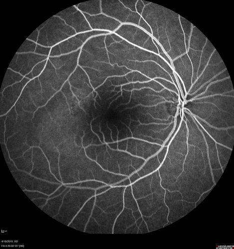 Central Serous Chorioretinopathy - Moderate
49 year old man with episodes in 2011, 2017, and 2018 - now with some paracentral vision loss in the right eye and subretinal fluid.
