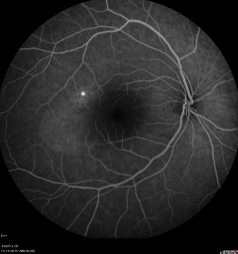 Central Serous Chorioretinopathy - Moderate
49 year old man with episodes in 2011, 2017, and 2018 - now with some paracentral vision loss in the right eye and subretinal fluid.

