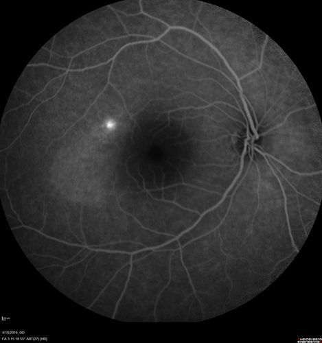Central Serous Chorioretinopathy - Moderate
49 year old man with episodes in 2011, 2017, and 2018 - now with some paracentral vision loss in the right eye and subretinal fluid.
