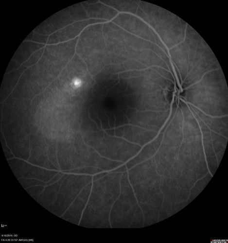 Central Serous Chorioretinopathy - Moderate
49 year old man with episodes in 2011, 2017, and 2018 - now with some paracentral vision loss in the right eye and subretinal fluid.
