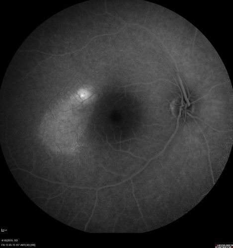 Central Serous Chorioretinopathy - Moderate
49 year old man with episodes in 2011, 2017, and 2018 - now with some paracentral vision loss in the right eye and subretinal fluid.
