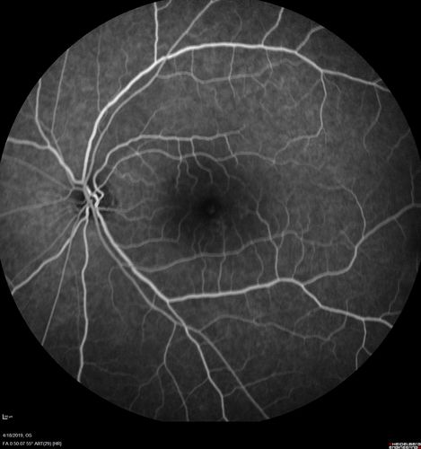 Central Serous Chorioretinopathy - Moderate
49 year old man with episodes in 2011, 2017, and 2018 - now with some paracentral vision loss in the right eye and subretinal fluid.
