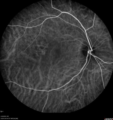 Central Serous Chorioretinopathy - Moderate
49 year old man with episodes in 2011, 2017, and 2018 - now with some paracentral vision loss in the right eye and subretinal fluid.
