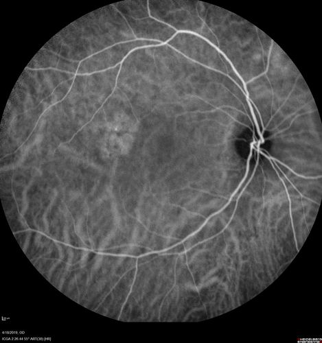 Central Serous Chorioretinopathy - Moderate
49 year old man with episodes in 2011, 2017, and 2018 - now with some paracentral vision loss in the right eye and subretinal fluid.
