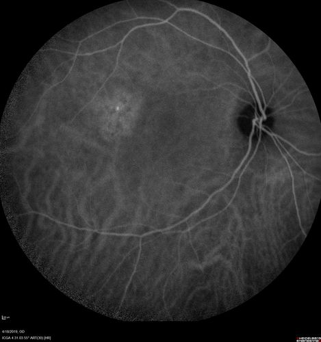 Central Serous Chorioretinopathy - Moderate
49 year old man with episodes in 2011, 2017, and 2018 - now with some paracentral vision loss in the right eye and subretinal fluid.
