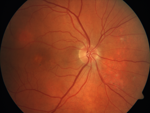 Chronic CSC Both Eyes - Recent vision loss Right Eye Treated with PDT
50 year old man The right eye has had vision loss for a few weeks.  He had previous episodes seen by me in 2012 OS and 2008 OD.  This was 2018. VA OS has been poor for several years.  
VA OD: Dcc20/100 
VA OS: Dcc20/200-3
The patient had PDT to leaky area superotemporal to the fovea 1/2 dose and within 3 months was back up to 20/25.  The last two OCT scans show fluid absorbing
